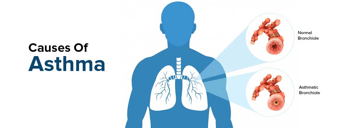 Causes of Asthma