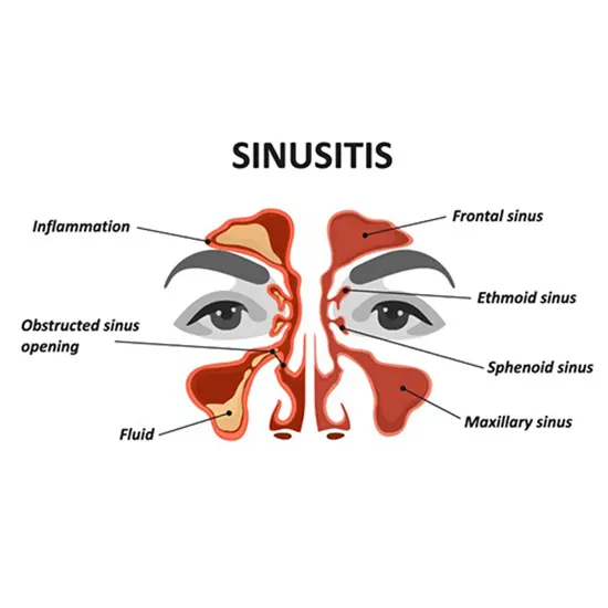 Sinusitis - Symptoms, Types, Causes & Diagnosis