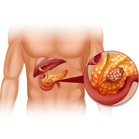 Pancreatitis - Symptoms, Types, Causes & Diagnosis