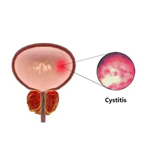Cystitis: Causes, Symptoms, Diagnosis and Treatment