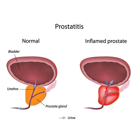 Prostatitis - Symptoms, Types, Causes & Diagnosis