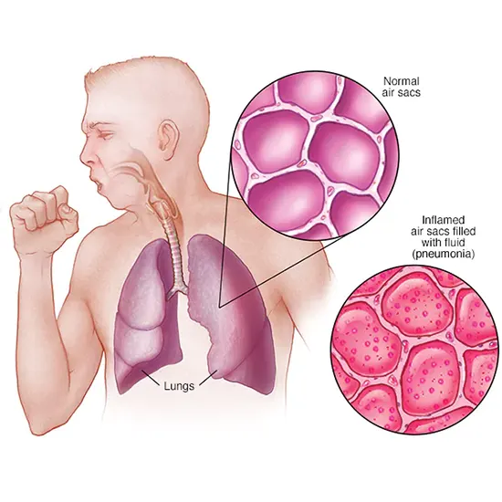 Pneumonia - Symptoms, Types, Causes & Diagnosis