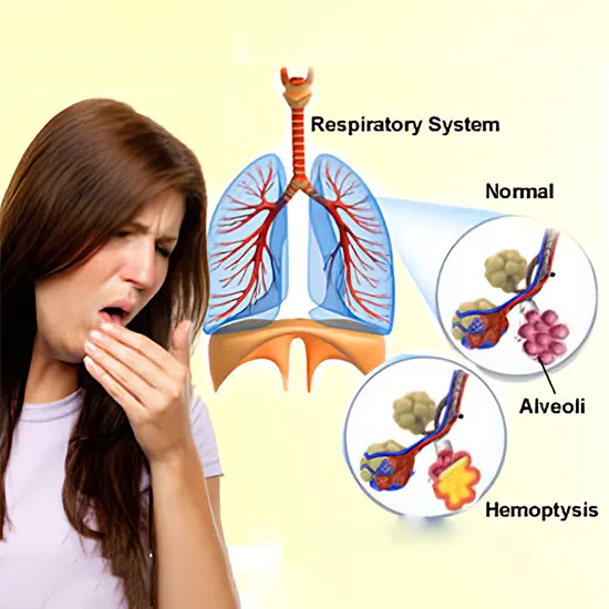 Hemoptysis: An Overview, Causes, Diagnosis & Treatment
