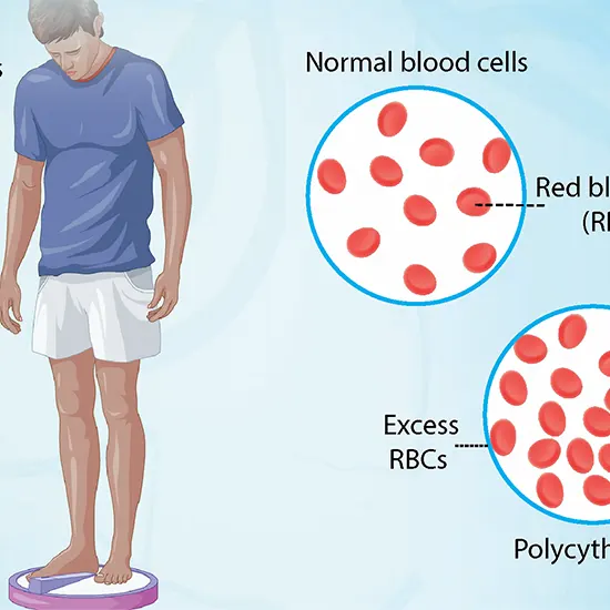 Polycythemia: What It Is, Causes, Symptoms & Treatment