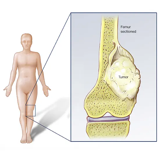 Osteosarcoma - Symptoms, Types, Causes & Diagnosis