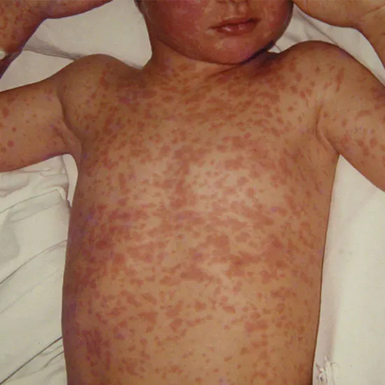 Measles : The Preventable Disease