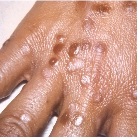 Smallpox : The Deadliest Disease in History and How We Defeated It
