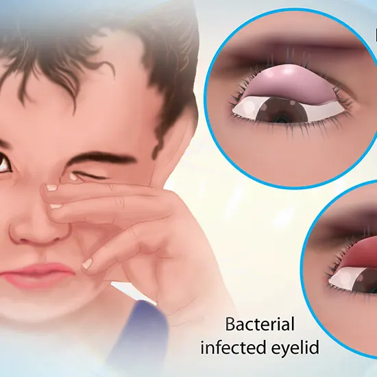 Trachoma, A Neglected Tropical Disease