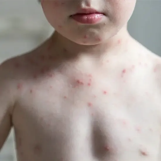 Feel Better, Faster : Say Goodbye To Fever And Rash | Ganesh Diagnostic