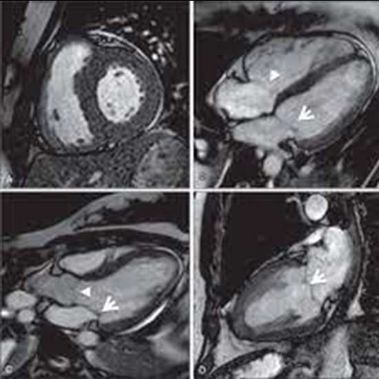 What is the Procedure of a Cardiac MRI?