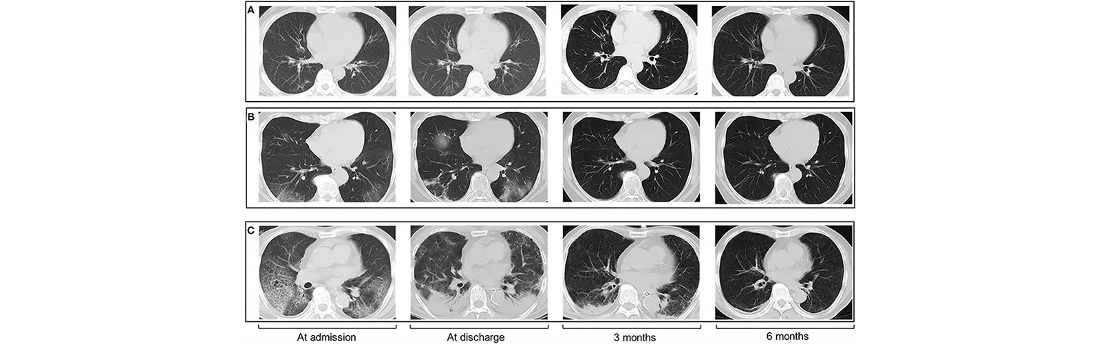 What is the Role of HRCT Chest in Cancer Detection?