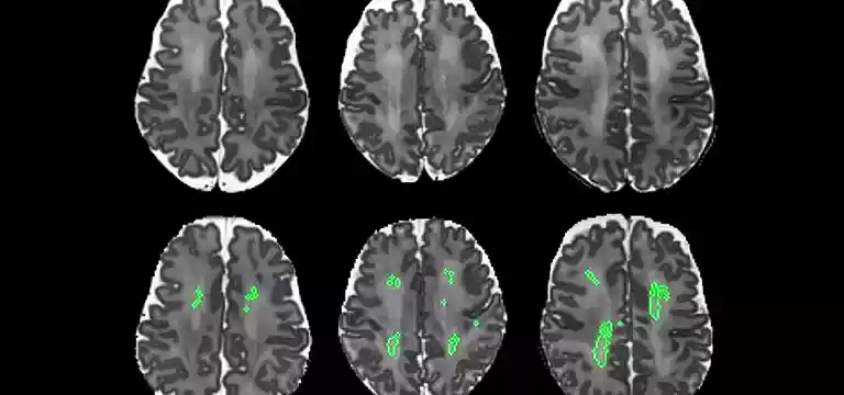 How can MRI help in treating Epilepsy?