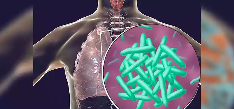 Sputum CBNAAT for Tuberculosis