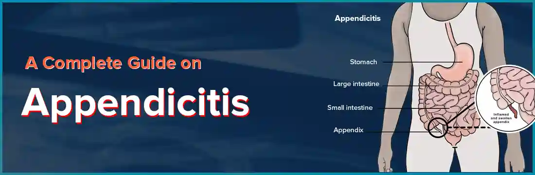 A Complete Guide on Appendicitis