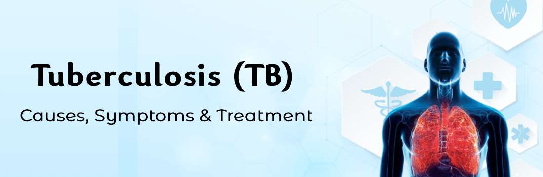 Tuberculosis (TB): A Survival Guide to End TB