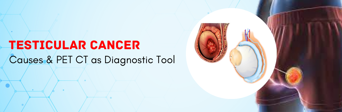Testicular Cancer: Causes and PET CT as Diagnostic Tool