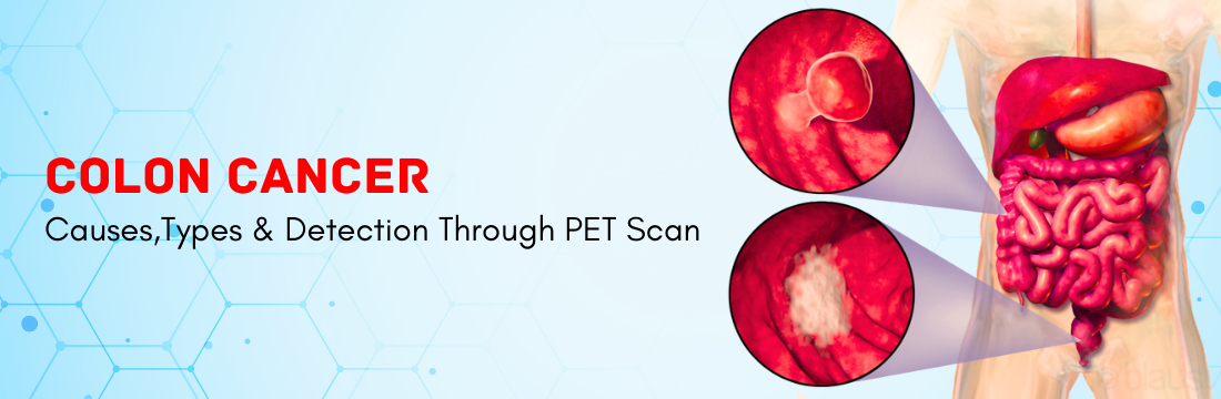 Colon Cancer Detection Through PET CT Scan | Ganesh Diagnostic