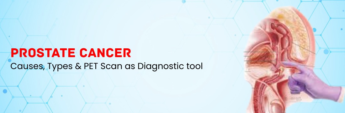 How to Diagnose Prostate Cancer through PET CT Scan