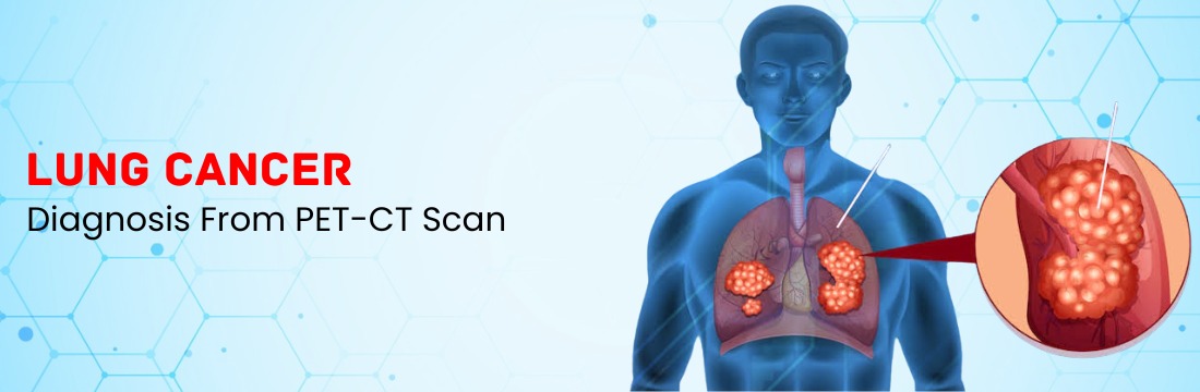 PET CT Scan for Lung Cancer | Bronchogenic Carcinoma | Ganesh Diagnostic