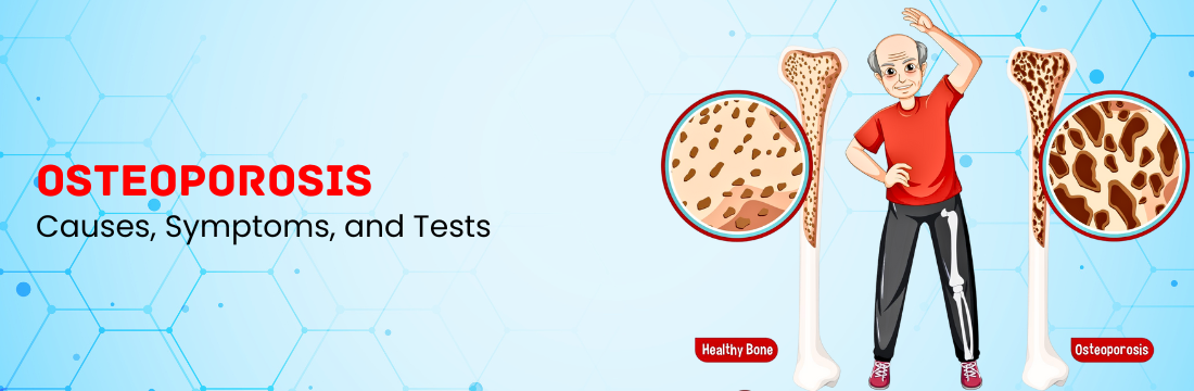 Osteoporosis: Its Causes, Symptoms, and Tests