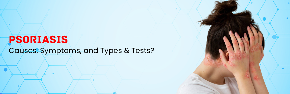 Psoriasis: What are the Causes, Symptoms, and Types & Tests?