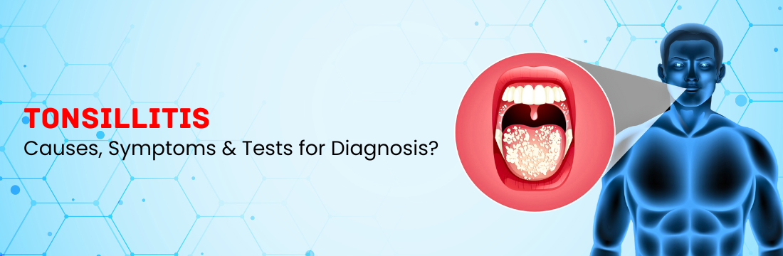 Tonsillitis: Reasons, Symptoms, Types, and Diagnosis Methods