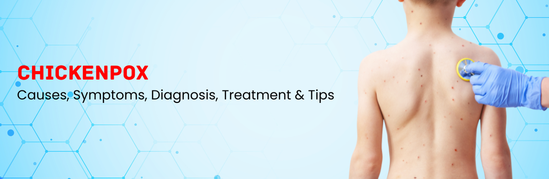 Chickenpox: Causes, Symptoms, Tests, Treatment, and Prevention