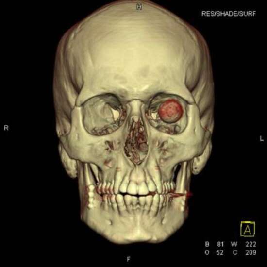 3D CT Face