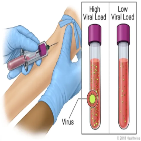 viral load (hiv) test