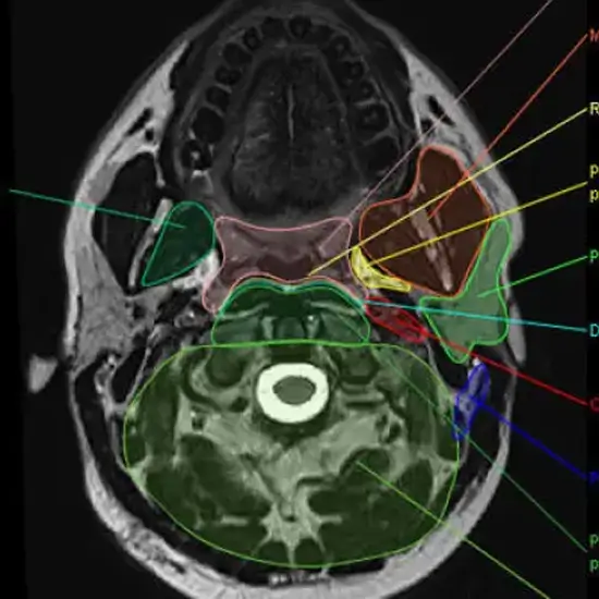 Фасции шеи кт. Пространства шеи кт. Кт крылонебной ямки кт анатомия. Мрт мягких тканей шеи (гортань, щитовидная железа, лимфоузлы). Окологлоточные клетчаточные пространства.