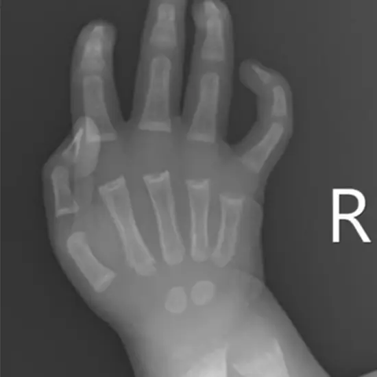 X-Ray Wrist For Rickets | Test Price in Delhi | Ganesh Diagnostic