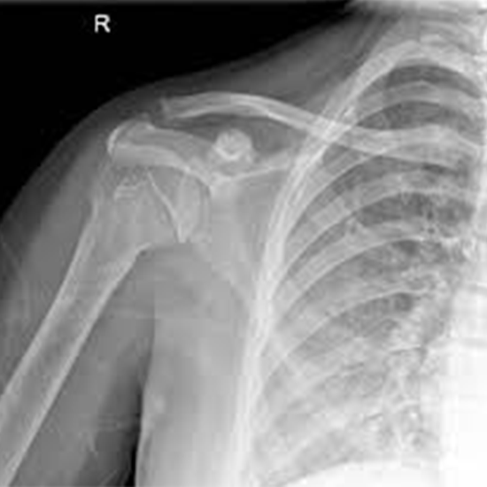 x-ray right shoulder joint ap