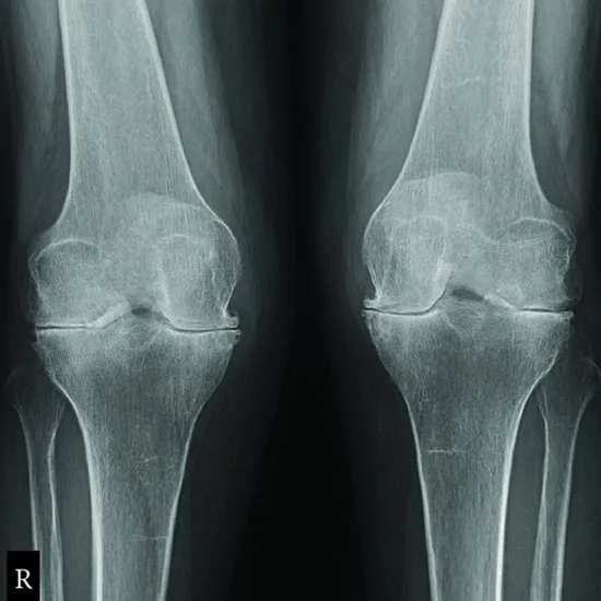 x-ray right knee joint ap lateral view