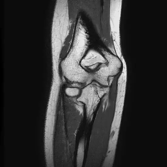 MRI Left Elbow Joint