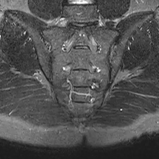 MRI Left SI Joints