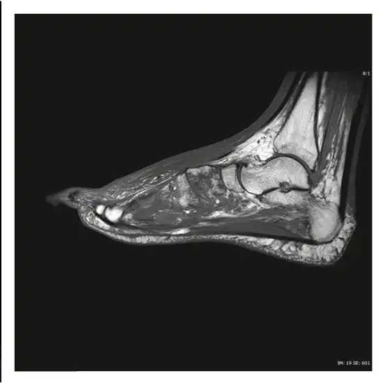 MRI Left Foot With Contrast