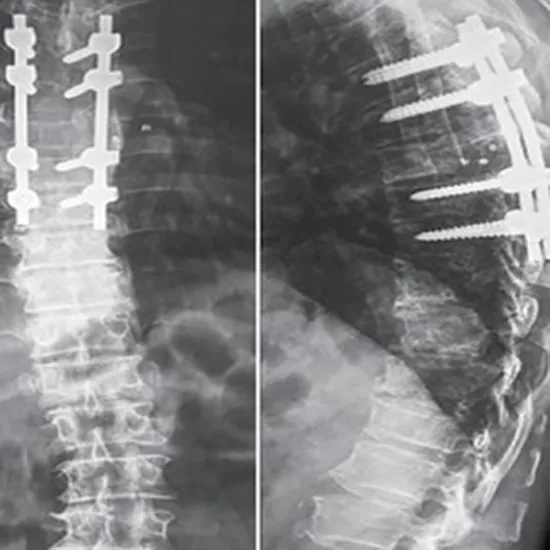x-ray of the thoracic spine (ap/lateral view)