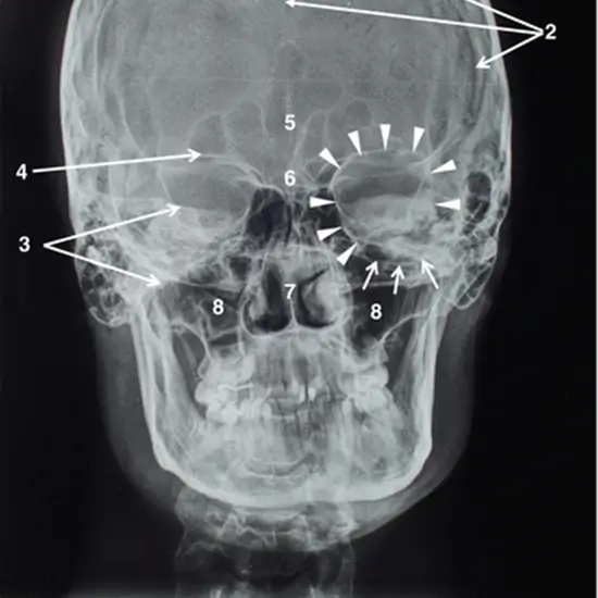x-ray optic foramen right
