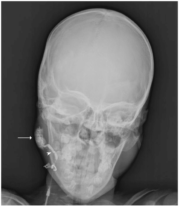 X-ray Parotid