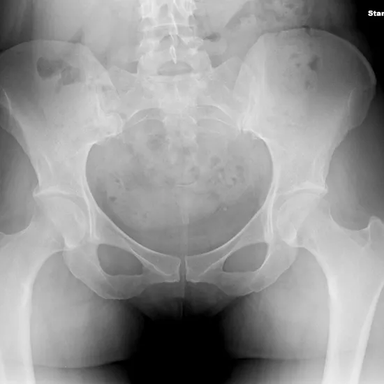 X-Ray Pelvis AP View