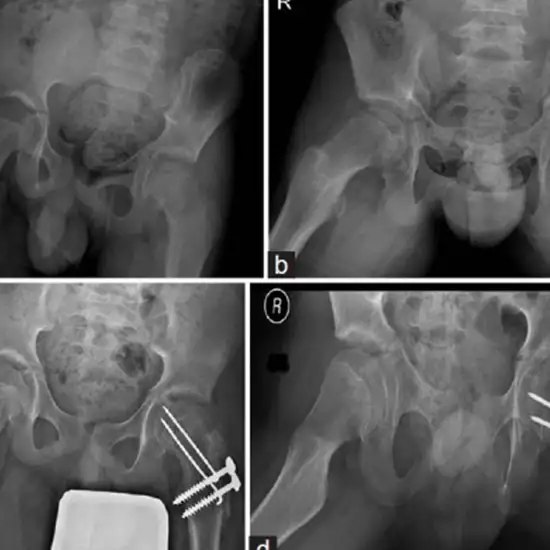 X-ray Pelvis Both Hips