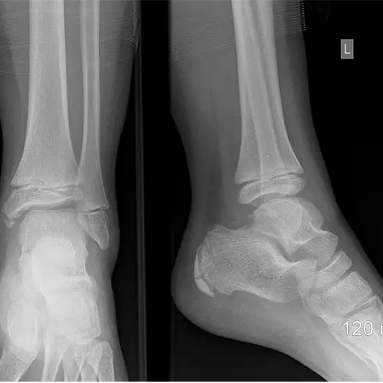 X-ray Right Ankle LAT View