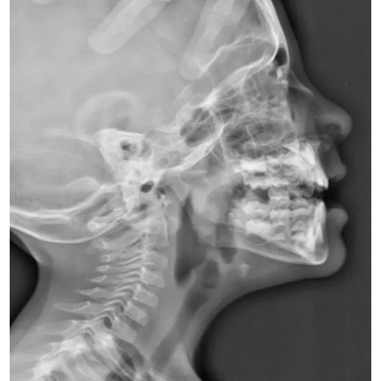 X-ray Nasal Bone LAT View