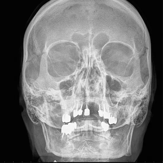 X-Ray Nasal Bone (AP View)