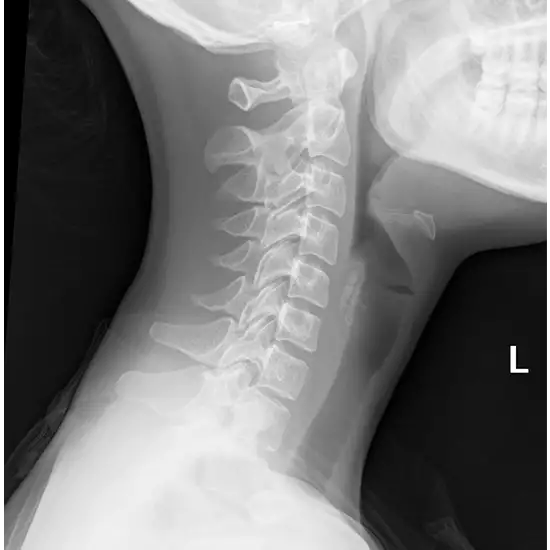 X-ray Neck AP LAT View