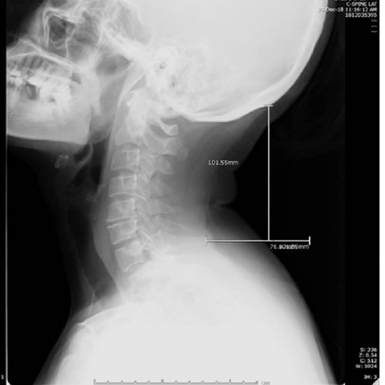 Xray Neck Lateral Test Price in Delhi Ganesh Diagnostic