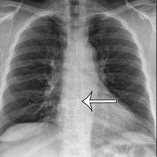 X-ray Oesophageal Area A.P. (F. Body)