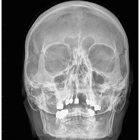 X-ray of Nasal Bone SI View