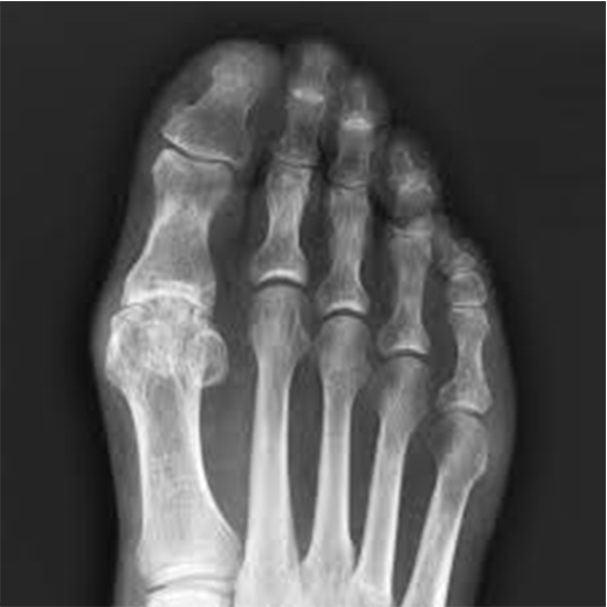 X-ray of the Right Big Toe AP & LAT