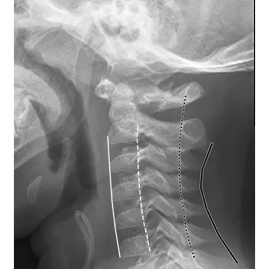 x-ray of the cervical dorsal